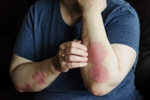 psoriasis causes